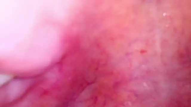 ENDOSCOPIO DEEP MOUTH BURP
